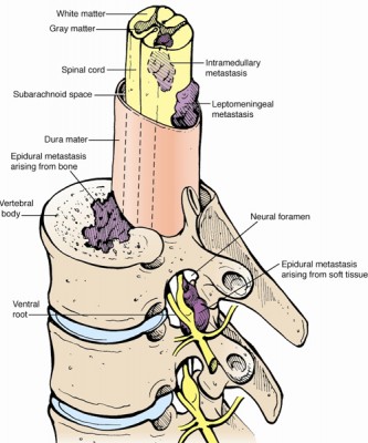 Spinal Tumor Types