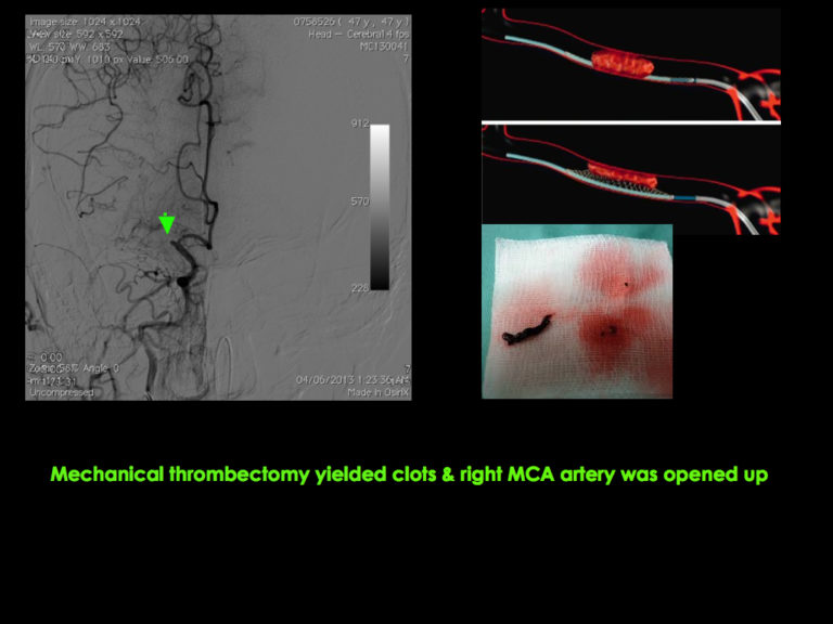 Middle Cerebral Artery - MCA3