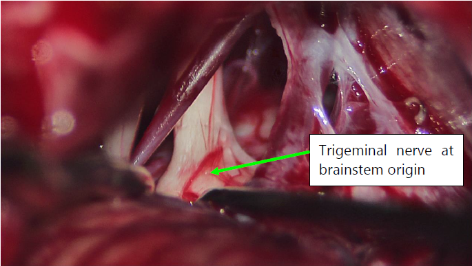 trigeminal nerve surgery
