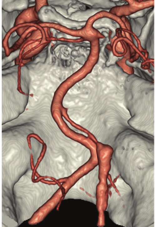 電腦腦血管造影顯示，梁太的小腦有腦血管動脈瘤爆破而導致嚴重出血性中風