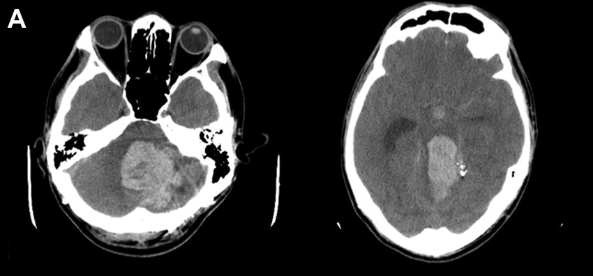 電腦掃瞄影顯示小腦的血塊壓着腦幹，造成腦積水及顱內壓偏高