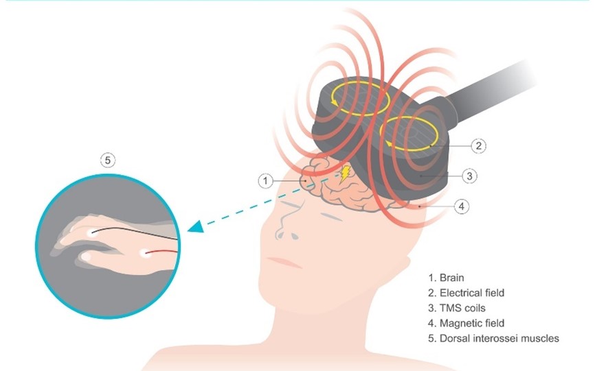 腦磁激療法 Transcranial Magnetic Stimulation TMS