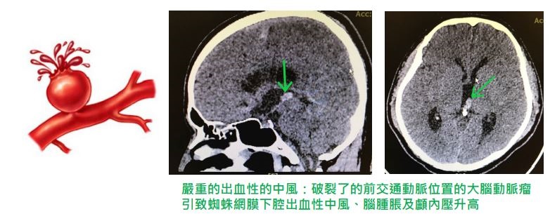 CT-Cerebral aneurysm