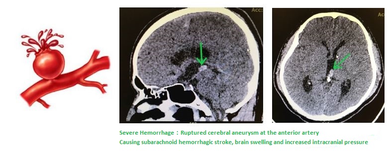 CT-Cerebral aneurysm-en