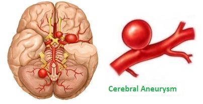 Cerebral aneurysm - HKBSSP en